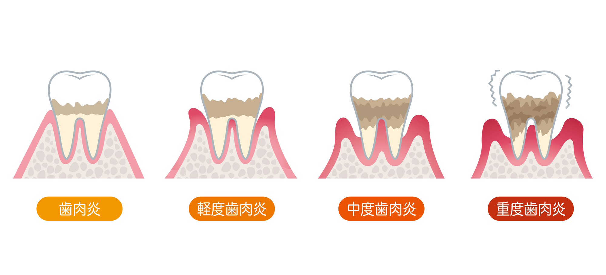 歯周病の進行